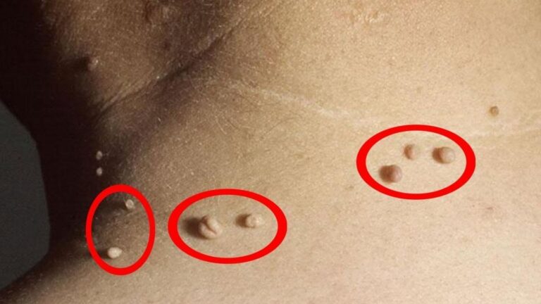 This forgotten trick helps you remove skin tags at home… you’ll be amazed!