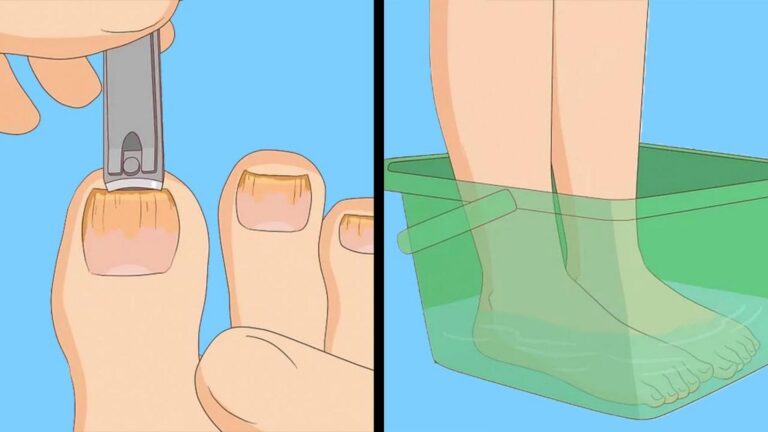 This simple routine will wipe out stubborn nail fungus for good…
