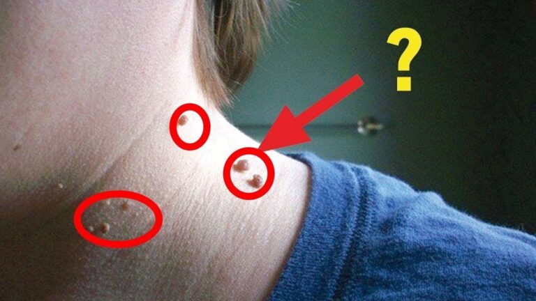Remove Skin Tags Fast: 5 Proven Methods You Need to Try Now!