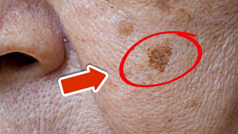 7 Secrets to Remove Age Spots Overnight with This Powerful Remedy!