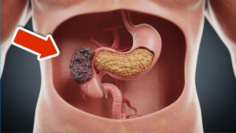 7 Early Cancer Warning Signs You Must Know to Protect Your Health!
