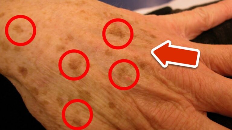 3 Essential Vitamins to Banish Age Spots for Good!