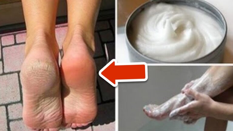 Eliminate Foot Fungus and Calluses Fast with This 1 Secret Home Remedy!