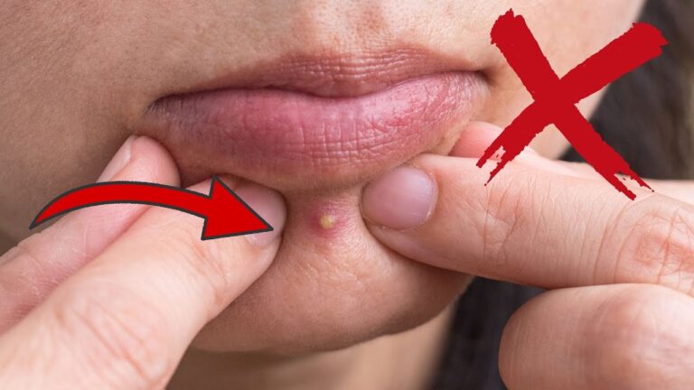 Avoid These 5 Spots for Popping Pimples – Keep Your Skin Flawless!