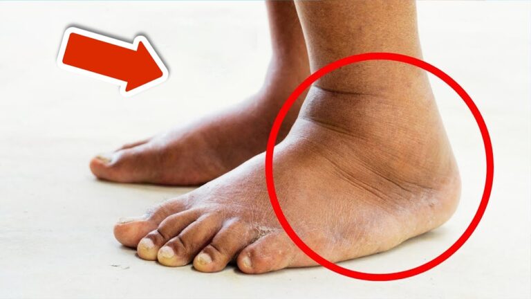 5 Effective Ways to Reduce Swelling in Legs and Feet Fast!