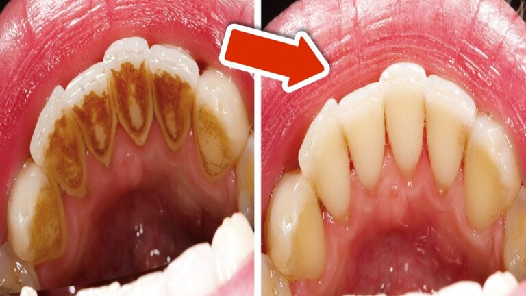 Remove 5 Types of Plaque at Home Without a Dentist – Discover the Easy Steps!