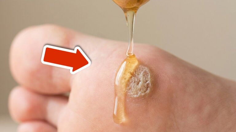 Remove 3 Types of Warts Fast with This Incredible Method!