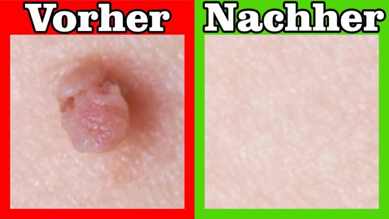 10 Uncommon Home Remedies to Quickly Remove Skin Tags!
