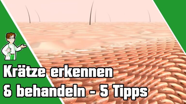 Discover 5 Essential Tips to Identify and Treat Scabies Effectively!