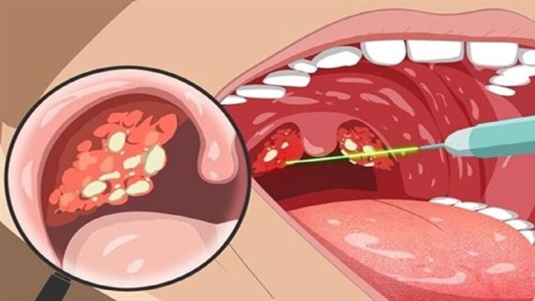 7 Warning Signs You Shouldn’t Ignore: See a Doctor for Your Throat Blisters!