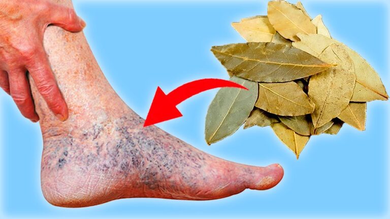 Say Goodbye to Varicose Veins and Pain with These 3 Amazing Foods!