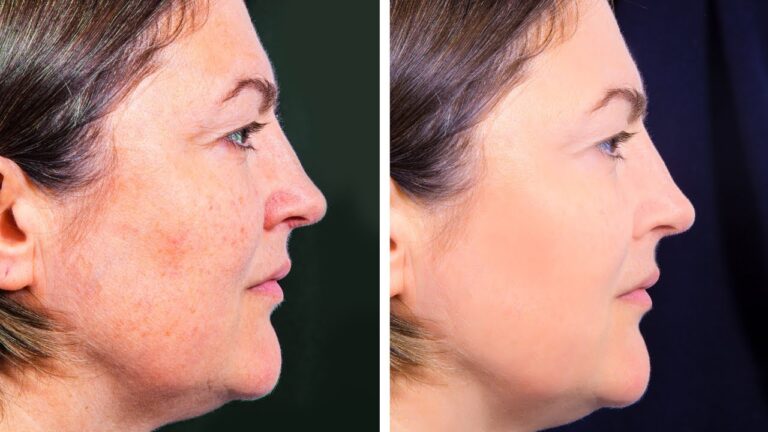 Remove 5 Skin Blemishes with These Simple Home Remedies Today!