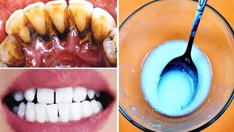 Remove Tartar in 2 Minutes with This Easy Mixture – Discover the Secret Now!