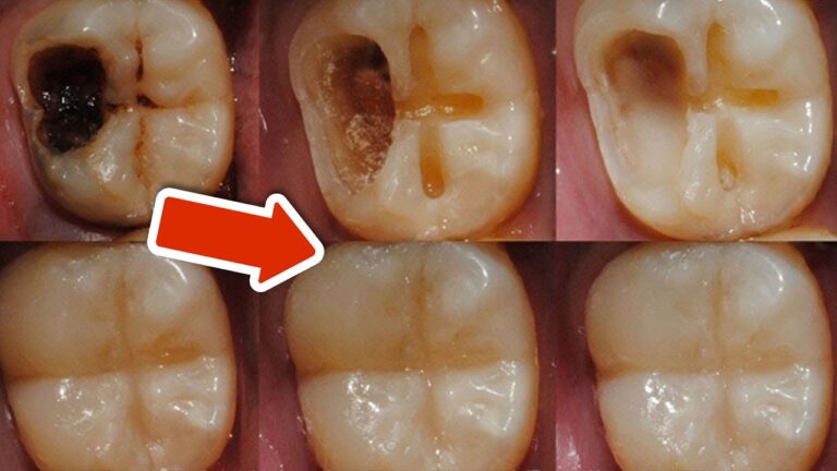 Stop Tooth Decay: 5 Simple Secrets You Need to Know Now!