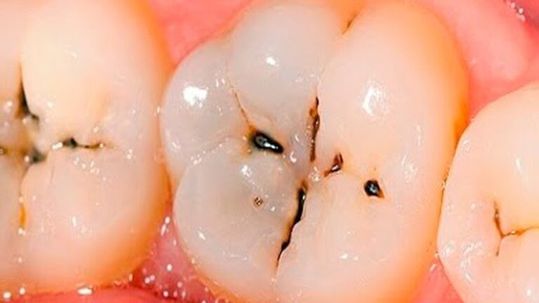 Beat Cavities: 5 Simple Tricks for a healthier smile!