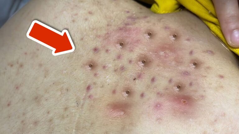 5 Quick Ways to Get Rid of Back Pimples for Clear Skin!