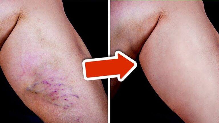 5 Fast Ways to Remove Varicose Veins Without Surgery You Need to Try!